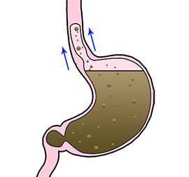 gastric-reflux-condition-gary-crosthwaite