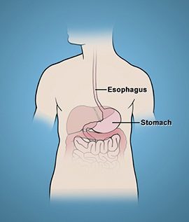 oesophageal-achalasia-condition-gary-crosthwaite