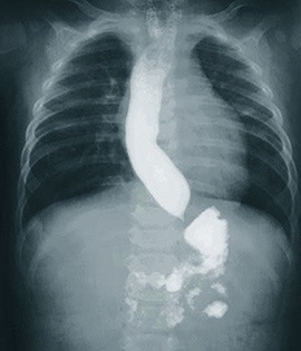 oesophageal-achalasia-condition-gary-crosthwaite