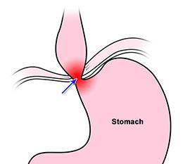 oesophageal-achalasia-condition-gary-crosthwaite