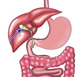 Gallbladder disease