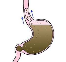 Gastro Oesophageal Reflux Disease (GORD)