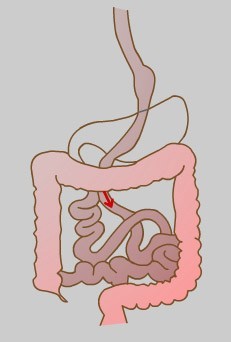 Gastric Roux-En-Y Bypass
