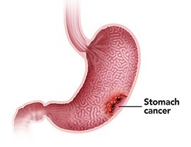 Gastrointestinal Cancer