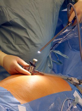 Laparoscopic surgery video clips
