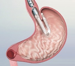 hiatal-hernia-treatment-gary-crosthwaite