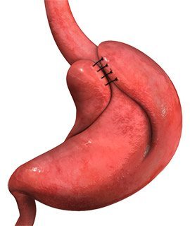 Nissen Fundoplication