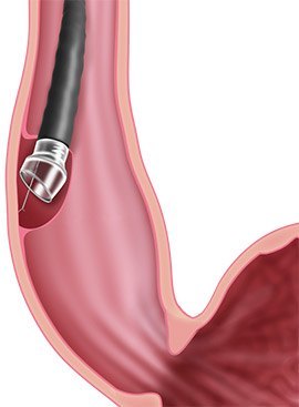 Laparoscopic Achalasia