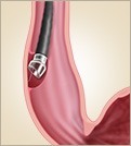 Per-oral Endoscopic Mytomy(POEM) - Assoc. Prof. Gary Crosthwaite - Upper Gastrointestinal and Cancer Surgeon MBBS, FRACS
