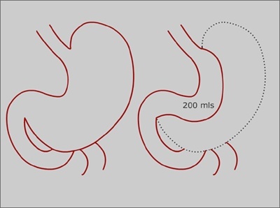 Tube Gastrectomy or Gastroplasty.